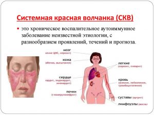 системная красная волчанка