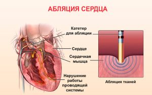 абляция сердца