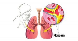 кашель при остром бронхите