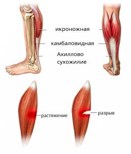 надрыв мышцы