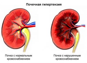 синдром почечной гипертензии