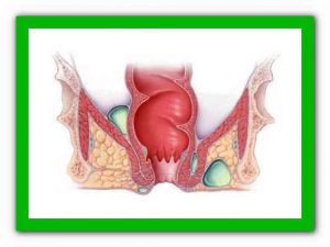 свищ заднего прохода