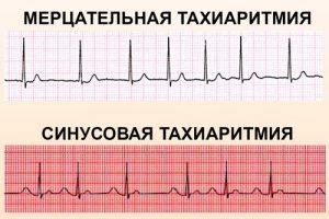 тахиаритмия