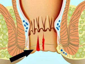 зуд в области ануса